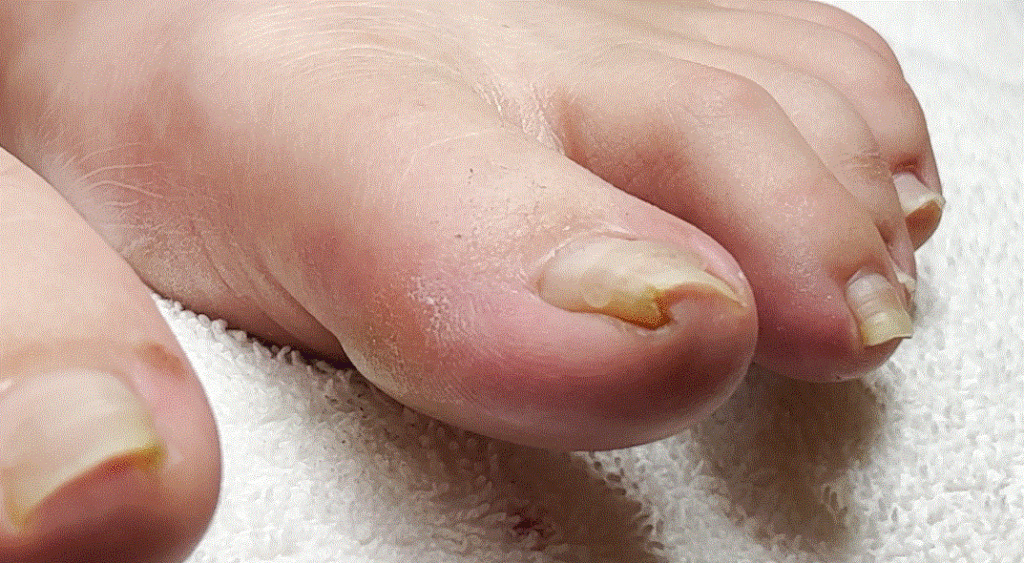 What Is a Pincer Toenail and Why You Should Care?